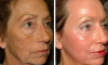 2 nemme måder at fjerne rynker i ansigtet derhjemme uden kirurgi og uden kosmetolog