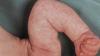 "Marmor" hud hos babyer: norm eller patologi? Neurolog svarer