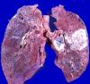 Lungekræft: hvordan man ikke skal gå glip af starten af ​​sygdommen?