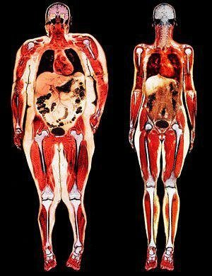 Venstre - bare visceral fedme. Alle organer kvæles med fedt.