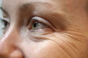 Hvordan undgår forekomsten af ​​rynker omkring øjnene