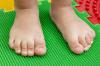 "Gode" og "onde" former for flade fødder hos børn