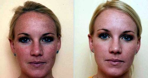 Carbon skrælning. Billeder før og efter. Patienten har fedtet hud type.