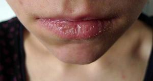 Hvor let at helbrede sprukne læber