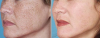 Det bedste middel mod pigmentering på ansigt, hals og décolleté. Effekten er mærkbar umiddelbart efter 1. brug