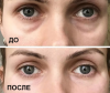 En billig maske 40 rubler korrektion Nasolacrimal riller: resultatet efter den første ansøgning. Kosmetolog er ikke længere nødvendig