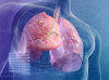 Tumoren i lungen: 5 Signs