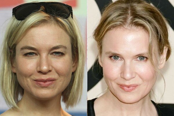 Skuespillerinde Zellweger før og efter øverste blepharoplasty
