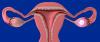 Ovariecyster: 4 alarm symptom