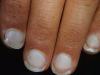 Hvorfor blege fingernegle