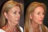 Hvordan er almindelige kvinder 50-70 år, som har gjort en ansigtsløftning