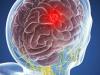 Brain tumor: 5 symptomer, som ikke kan ignoreres