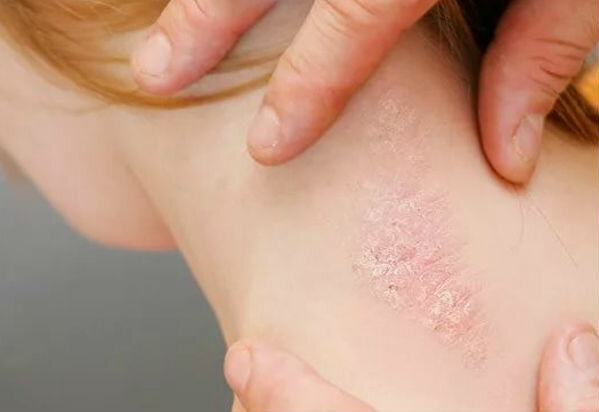 Psoriasis