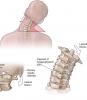 4 grundlæggende øvelser for halshvirvelsøjlen vil bidrage til at glemme alt om den smerte og osteochondrose!