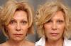 Hvordan gør Botox og hvorfor nogle berømtheder efter det "forvrænget" ansigter