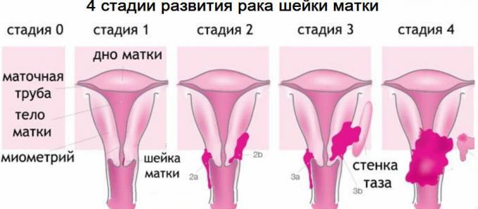 4 til livmoderhalskræft