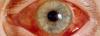 Den akutte glaukom: hvad det er, hvordan man behandler?
