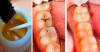 Hvordan at slippe af med huller i tænderne derhjemme