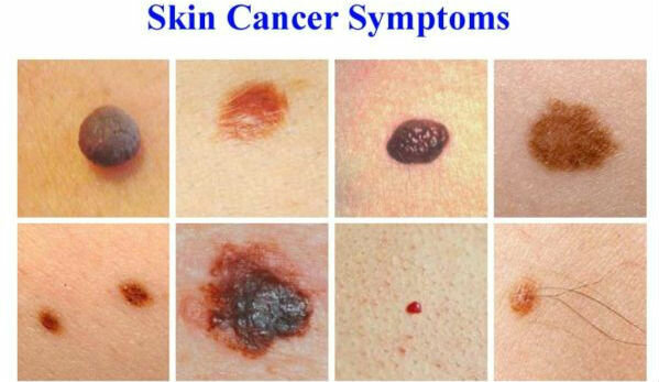 Symptomer på hudkræft