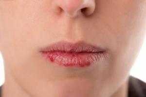 5 tips om hvordan man kan forebygge revner i læber